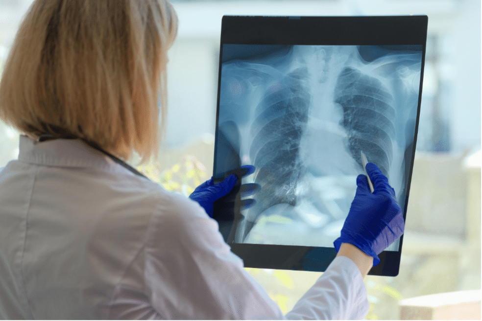 Pljučna fibroza: vzroki, simptomi in osebna zgodba