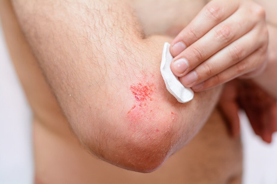 Hemofilija – bolezen, s katero se da živeti