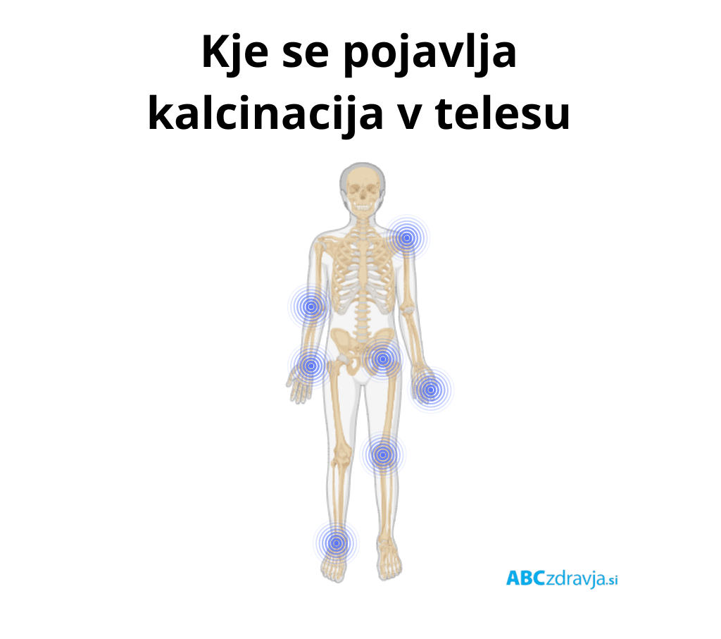 kje se pojavlja kalcinacija