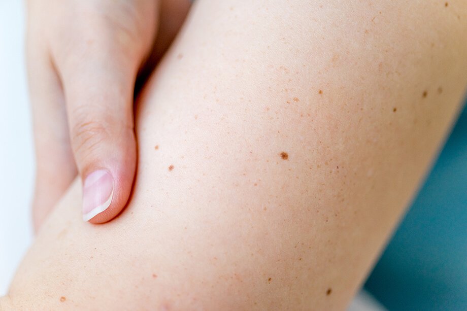 Motnje pigmentacije so običajno le estetska nadloga