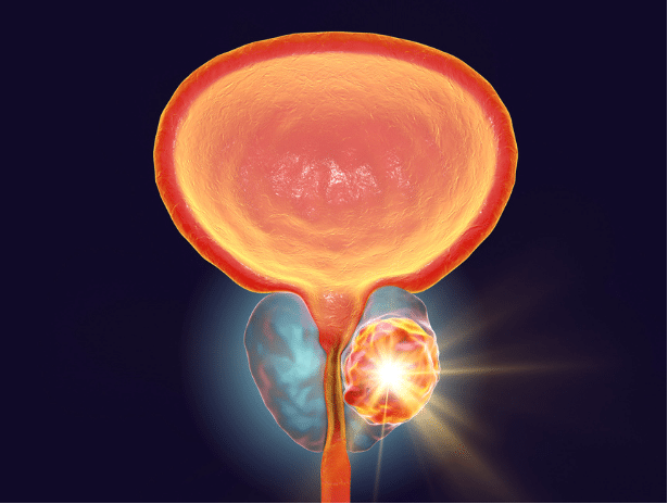 rak prostate zdravljenje